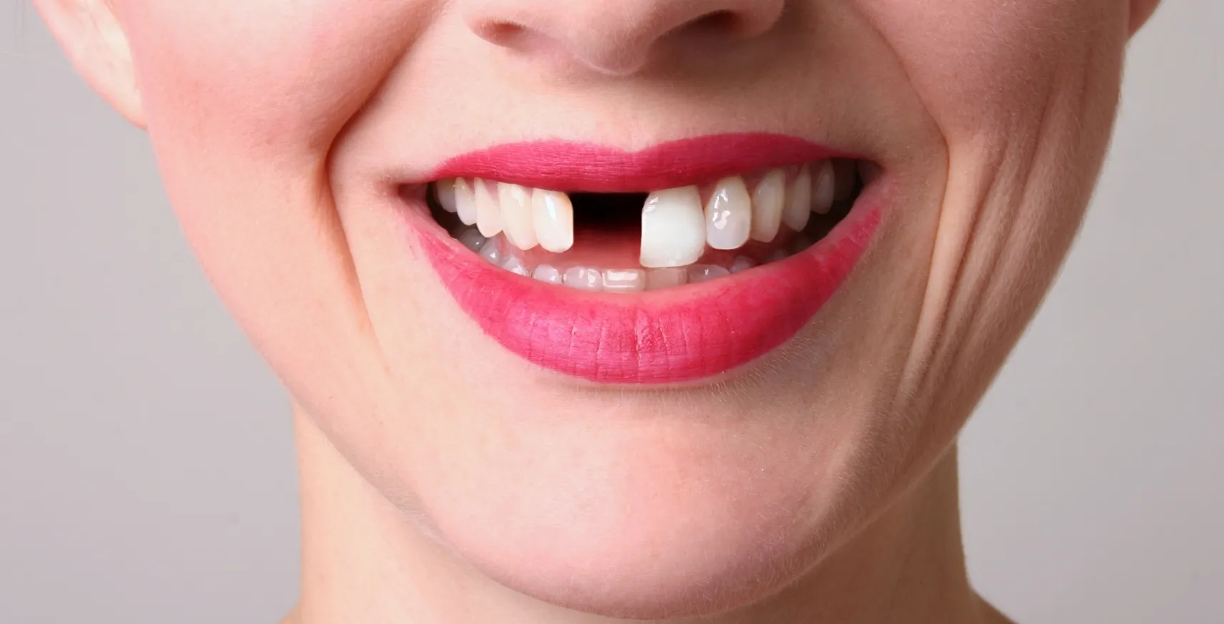 Implantes dentales: ¿cuándo son necesarios y por qué no debes posponerlos?