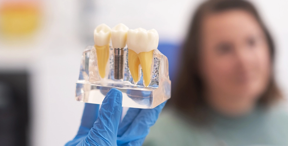 Implantes dentales: cuando volver a sonreír lo cambia todo