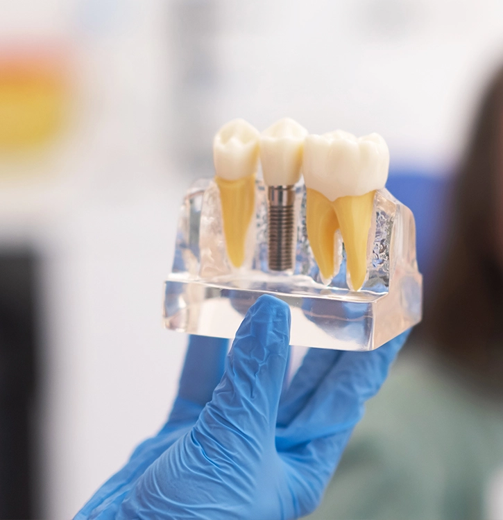 Implantes dentales: cuando volver a sonreír lo cambia todo