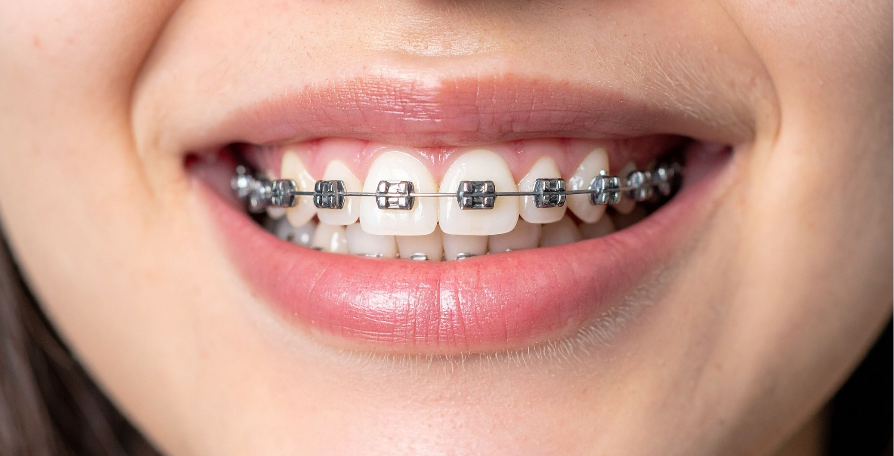 Ortodoncia invisible vs. brackets tradicionales: ¿cuál te conviene?