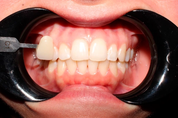 Antes: Blanqueamiento dental