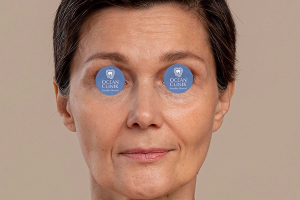 Antes: Full Face con Ácido Hialurónico