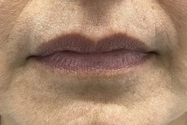 Antes: Hidratación Labial con Ácido Hialurónico