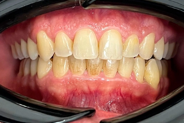 Antes: Limpieza Dental con Bicarbonato