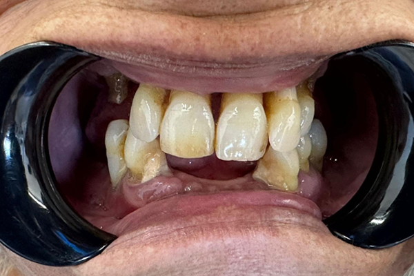 Antes: Rehabilitación Total por Implantes Dentales