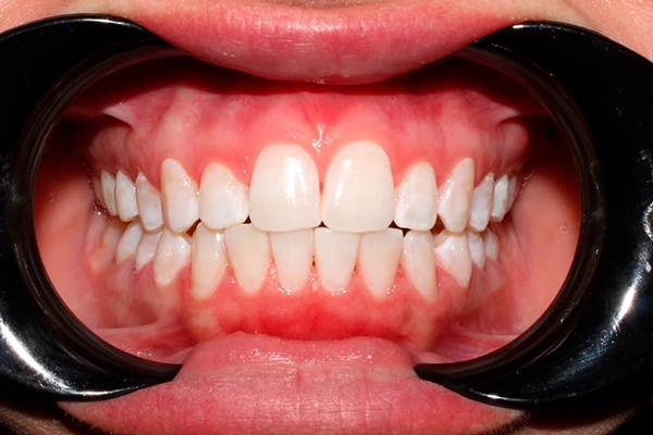 Después: Blanqueamiento dental