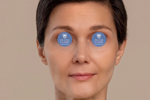 Después: Full Face con Ácido Hialurónico