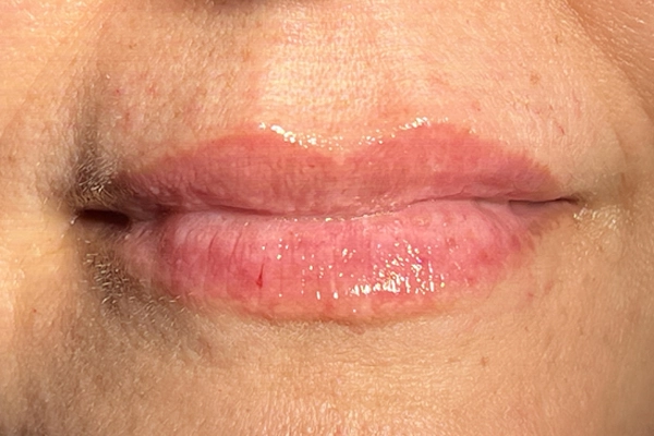 Después: Hidratación Labial con Ácido Hialurónico