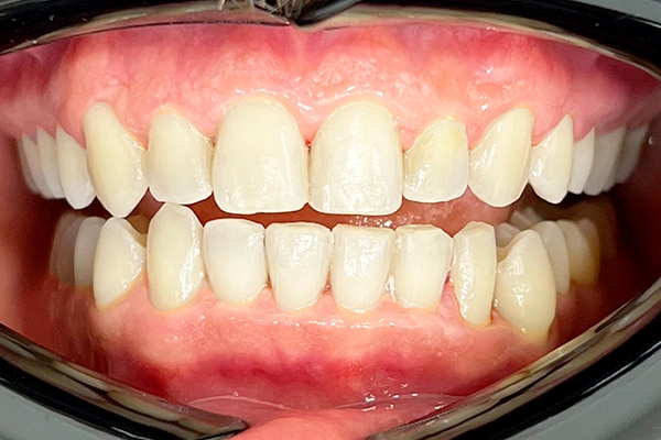 Después: Limpieza Dental con Bicarbonato