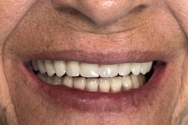 Después: Rehabilitación Total por Implantes Dentales