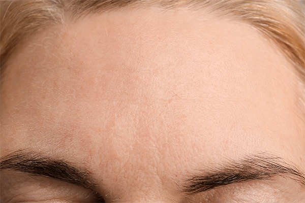 Después: Tratamiento de arrugas del tercio superior con toxina botulínica